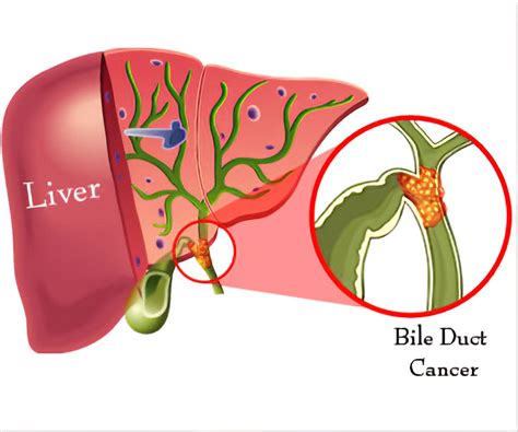 liver cancer near roseville|Liver and Bile Duct Cancer .